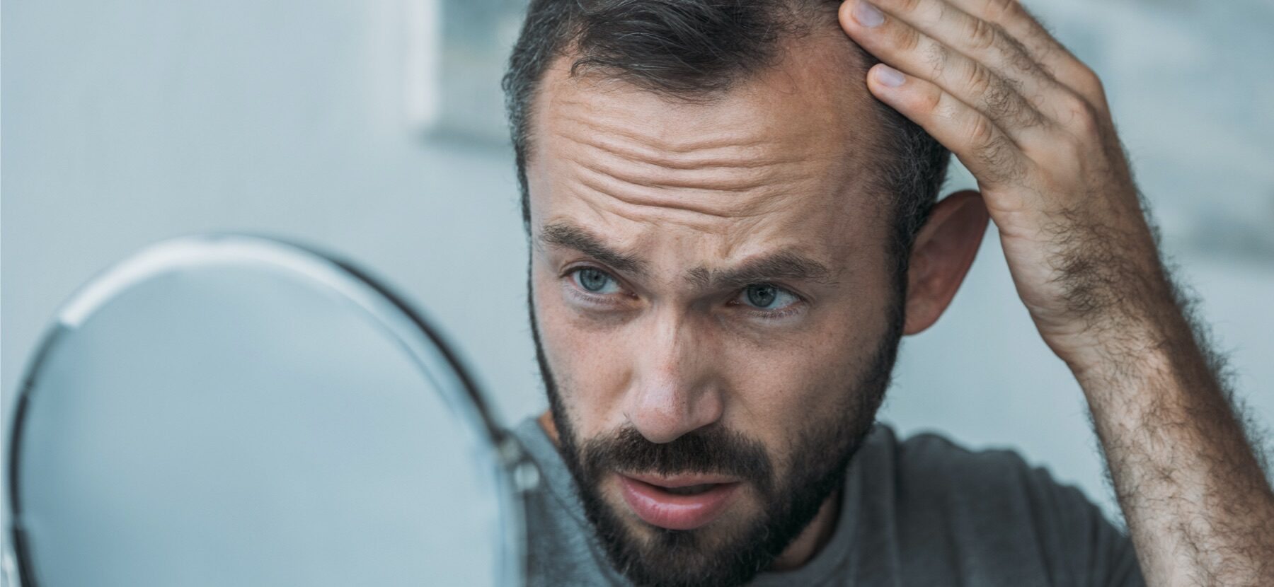 Haarausfall: Mann untersucht seinen Haaransatz